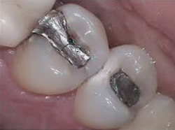 Amalgam - Ein umstrittener Werkstoff in der Zahnheilkunde