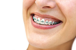 Zahnspange korrigiert bei Teenager Zahnfehlstellungen