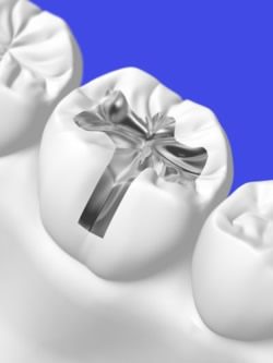 Zahnfüllung eines Backenzahns