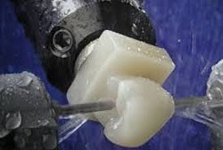 Cerec ermöglicht Zahnrestaurierungen in nur einem Behandlungstag