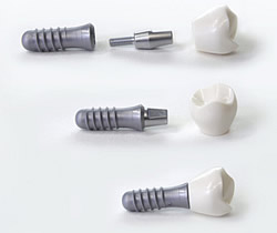 Zahnimplantate ermöglich Zahnersatz wie gewachsene Zähne