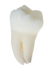 Die Zahnkrone bildet den sichtbaren Teil des Zahns